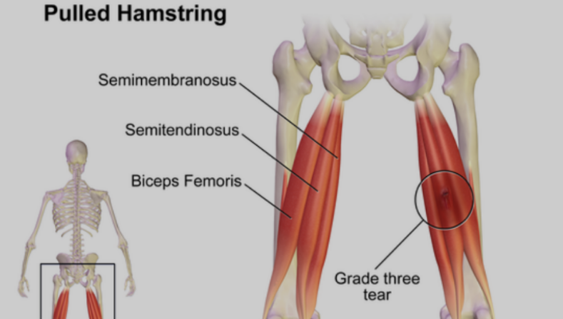 HAMSTRING INJURY IN CHILDREN
