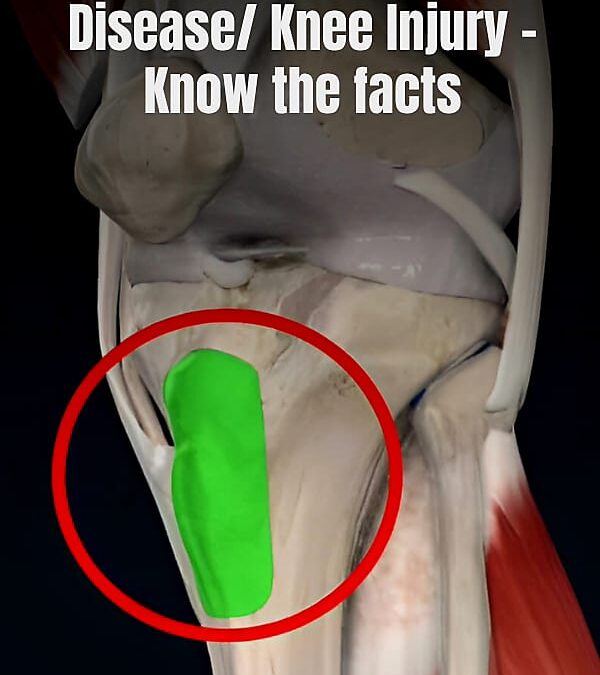 Osgood Schlatters Disease/ Knee Injury – Know the facts